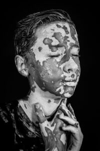 ニキビ跡の色素沈着が消えるまでの期間はどのくらい？