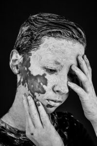 ニキビ跡の色素沈着を男性が治すための効果的な方法は？