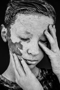 男性ニキビ跡の色素沈着を消す方法は？